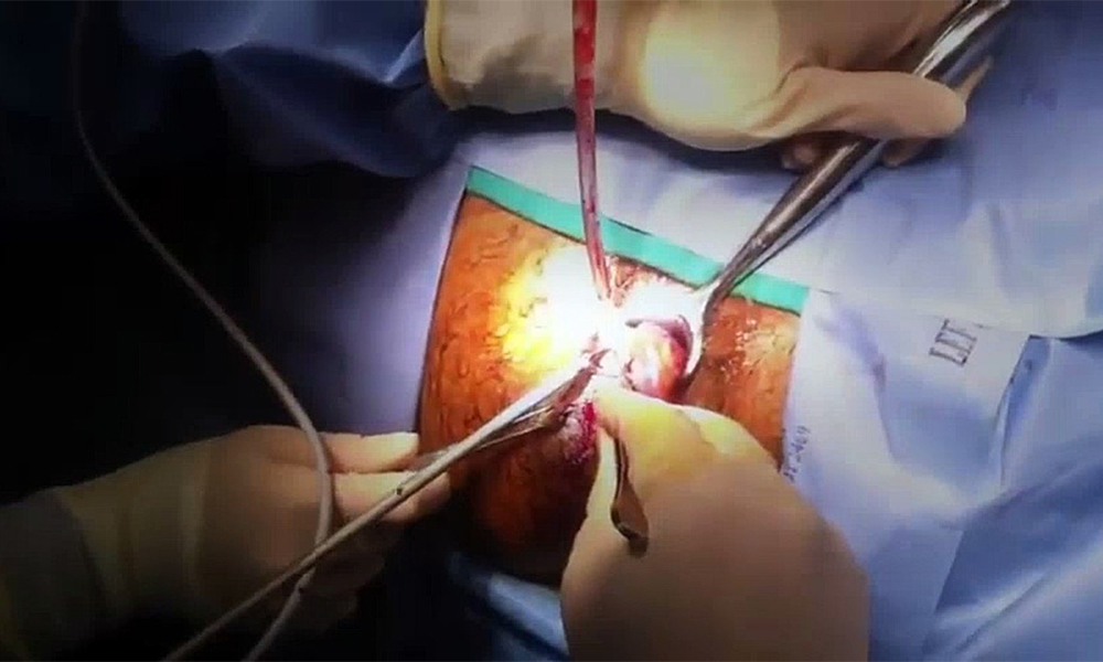 Laser Treatment for Piles in Kathmandu